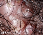 folliculitis cheloidalis