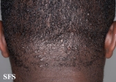 folliculitis cheloidalis