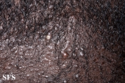 folliculitis cheloidalis