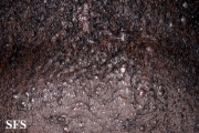 folliculitis cheloidalis
