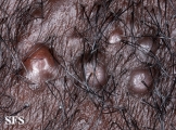 folliculitis cheloidalis