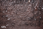 folliculitis cheloidalis