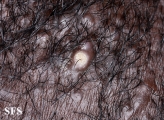 folliculitis cheloidalis