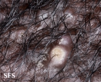 folliculitis cheloidalis