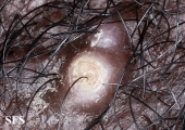 folliculitis cheloidalis