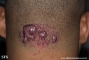 folliculitis cheloidalis