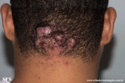 folliculitis cheloidalis
