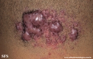 folliculitis cheloidalis
