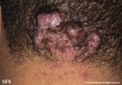 folliculitis cheloidalis