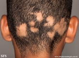 alopecia areata