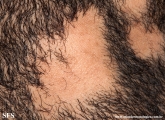alopecia areata