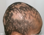 alopecia areata