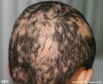 alopecia areata