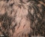 alopecia areata