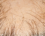 alopecia areata