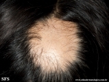 alopecia areata