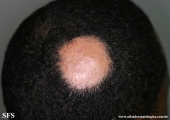 alopecia areata