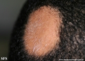alopecia areata