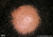 alopecia areata