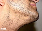 alopecia areata