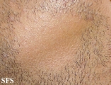 alopecia areata