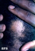 alopecia areata