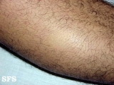 alopecia areata