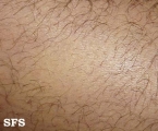 alopecia areata