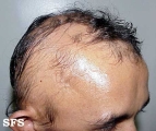 alopecia areata