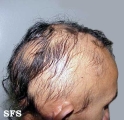 alopecia areata