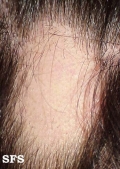 alopecia areata