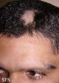 alopecia areata