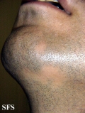 alopecia areata
