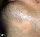 alopecia areata