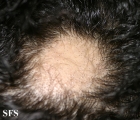 alopecia areata