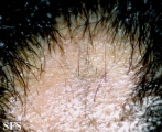 alopecia areata