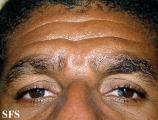 alopecia areata