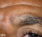 alopecia areata