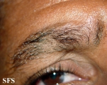 alopecia areata