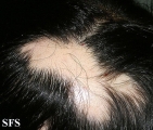 alopecia areata