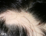 alopecia areata