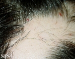 alopecia areata