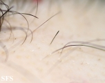 alopecia areata