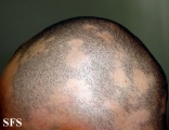 alopecia areata