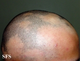 alopecia areata