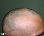 alopecia areata