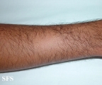alopecia areata