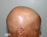 alopecia areata