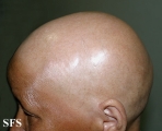 alopecia areata