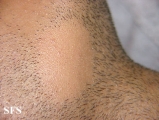 alopecia areata